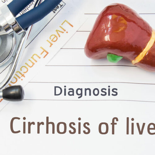 Liver Cirrhosis – Its Stages and Prevention