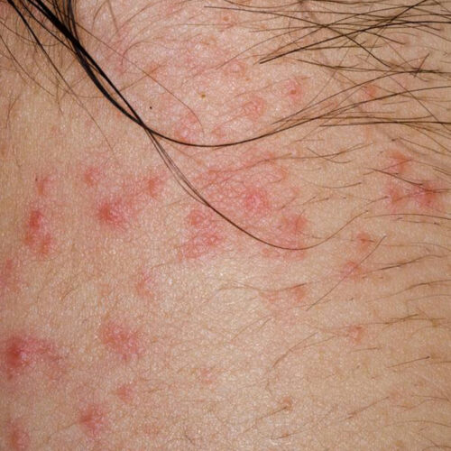 Curious about atopic dermatitis? Here’s what you need to know