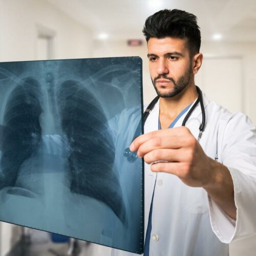 Lung Cancer – Causes, Symptoms, and Treatment