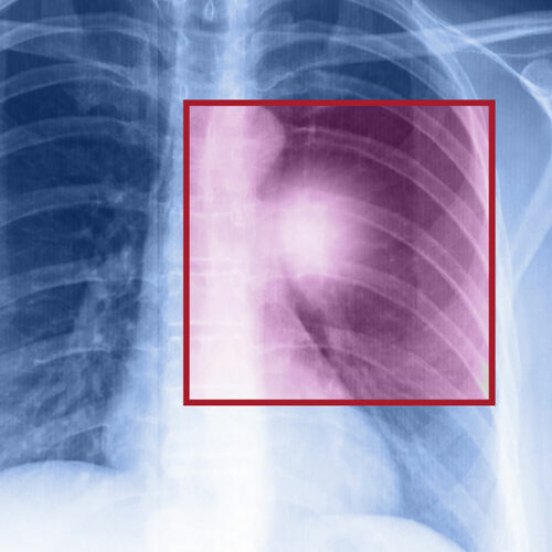 Lung cancer – Types, symptoms, and causes