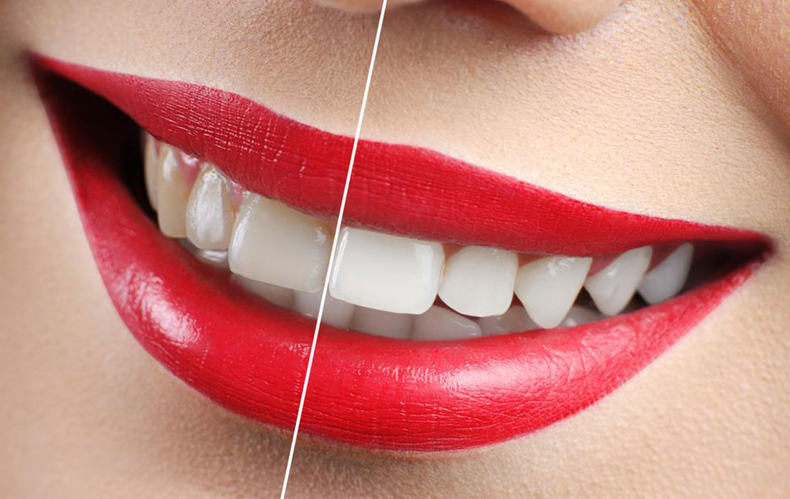 Yellow Teeth – How to avoid discoloration of teeth